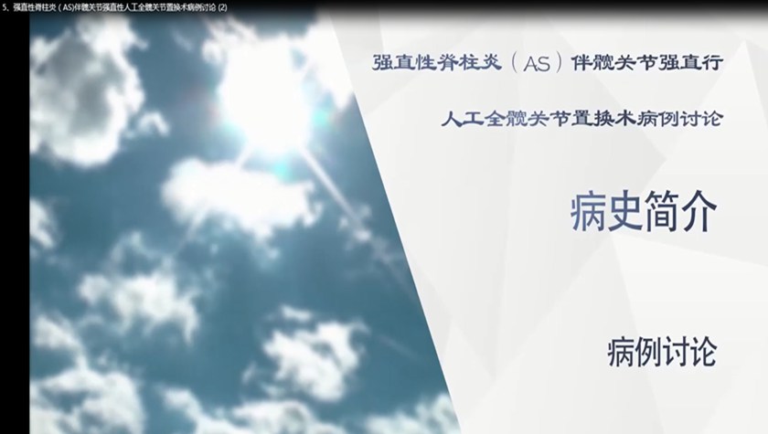 强直性脊柱炎 人工全髋关节置换术 强直性脊柱炎（AS)伴髋关节强直性人工全髋关节置换术病例讨论 (2)